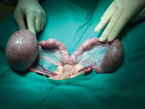 महिला के पेट से निकली 7 किलो की गांठ